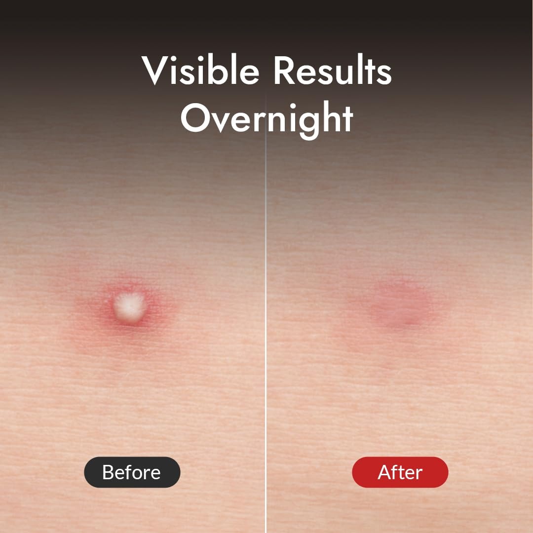 image:imageMIZON Good Bye Blemish Clear Patch Invisible Korean Acne Pimple Covering Zits Waterproof Nondrying Thin Cover Excellent Skin Adhesion Patch Spot Cover 44ea