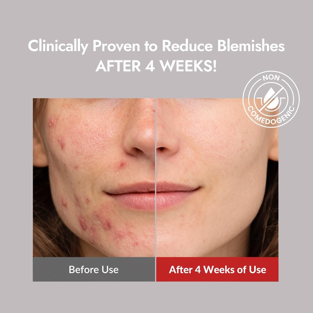 image:imageMIZON Good Bye Blemish Low pH Cleanser Cleanser for troubled skin Acne Treatment Breakout Treatment Korean Skincare Acne Spot Treatment Soothing for sensitive skin100ml 338 fl oz