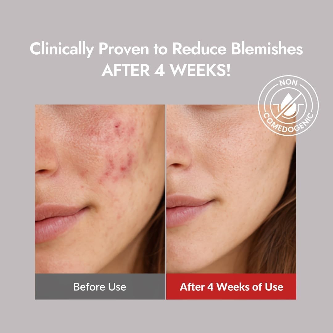 image:imageMIZON Goodbye Blemish Fresh Toner BHA Niacinamide for Excessive Sebum Troubled Skin Acne Treatment Breakout Treatment Korean Skincare Acne Spot Treatment Smooth Skin 120ml405 fl oz