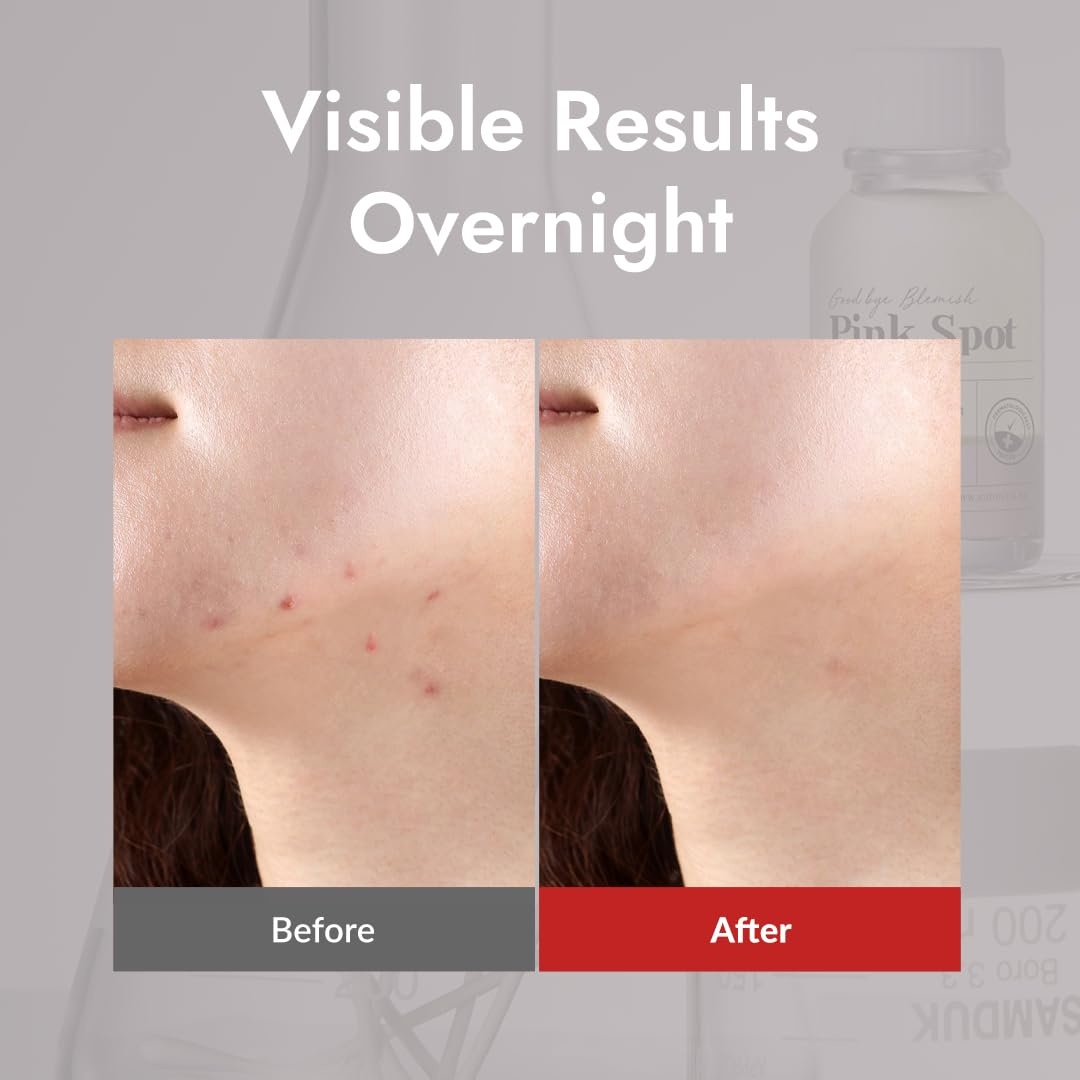 image:imageMIZON Pink Spot Overnight spot care Pimple Care Product with Calamine AHA BHA Acne treatment Breakout treatment 19ml065 fl oz
